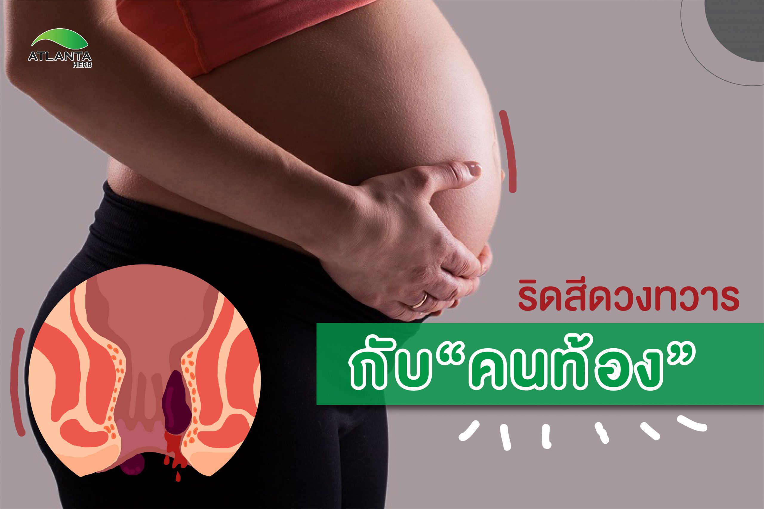 ริดสีดวงทวารกับคนท้อง_cover